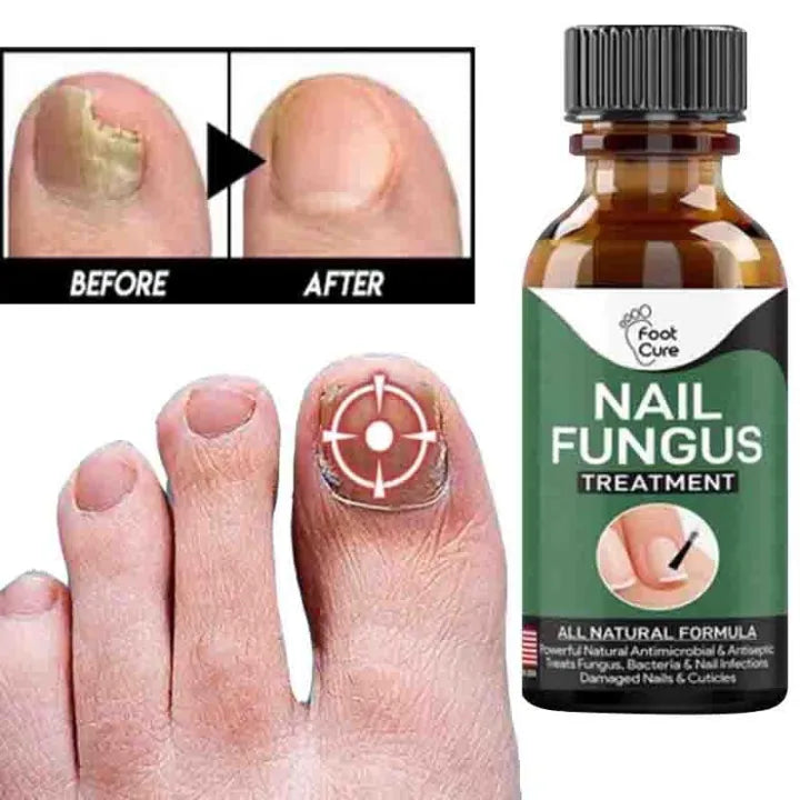 Fast Nail Fungus Treatment Serum